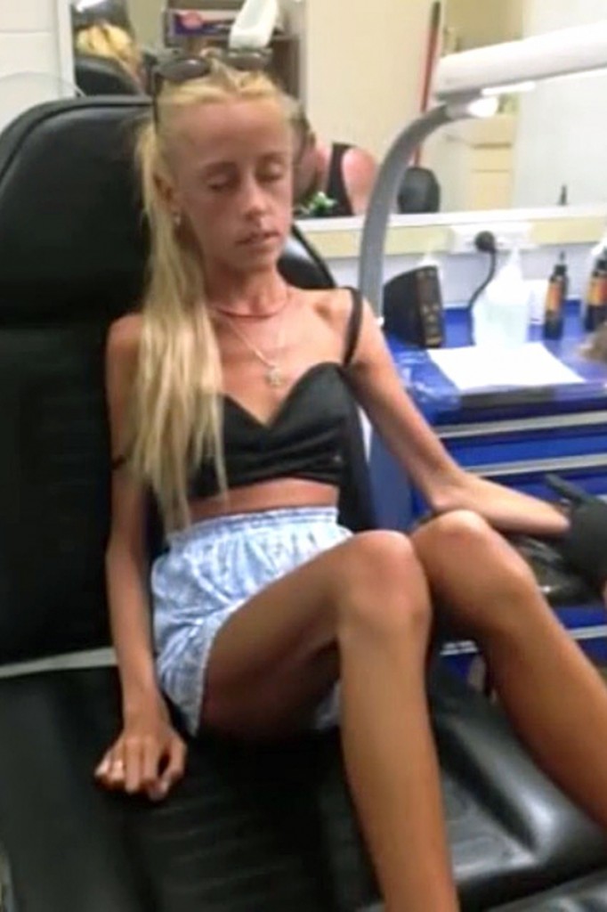 Teen Overcomes Anorexia After Near-Death Experience
