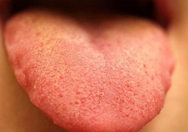 Узнайте о состоянии Вашего здоровья по языку (Фото)