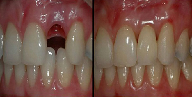 Революція в стоматології: Тепер кожен зможе виростити нові зуби за 9 тижнів!