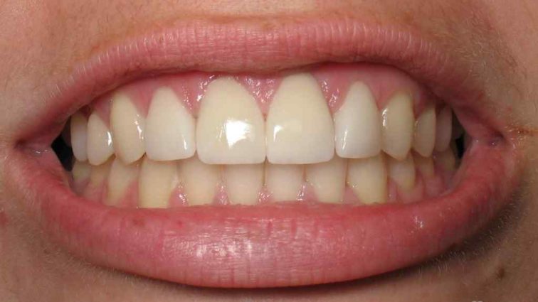 5 міфів про догляд за зубами